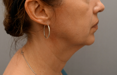 Jowl/Jawline Contouring Kybella Patient #6 Before Photo # 9