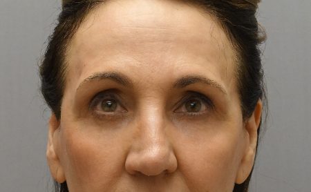 Upper and Lower Eyelid Blepharoplasty Patient #5 After Photo Thumbnail # 2