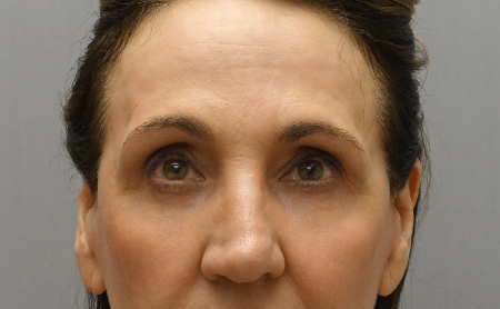 Upper and Lower Eyelid Blepharoplasty Patient #5 After Photo # 2