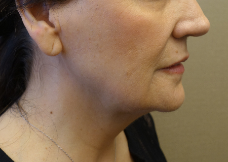Before Image: Jowl/Jawline Contouring Kybella Patient #1 -