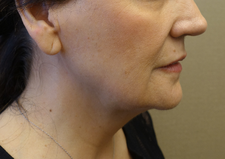 Jowl/Jawline Contouring Kybella Patient #1 Before Photo # 3