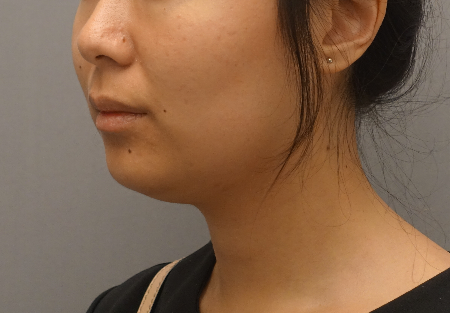 Kybella Patient #18 Before Photo # 7