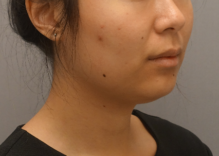 Kybella Patient #18 Before Photo # 3