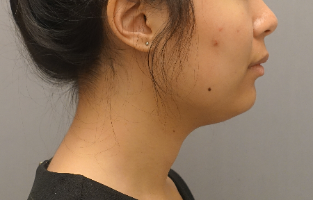 Kybella Patient #18 Before Photo # 5