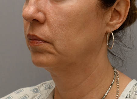 Jowl/Jawline Contouring Kybella Patient #6 After Photo Thumbnail # 6