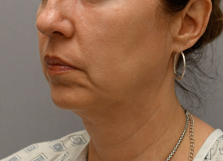 Jowl/Jawline Contouring Kybella Patient #6 After Photo # 6