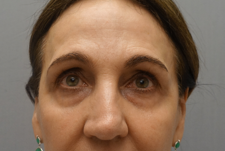 Upper and Lower Eyelid Blepharoplasty Patient #5 Before Photo Thumbnail # 3