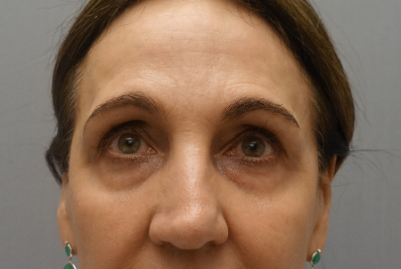 Upper and Lower Eyelid Blepharoplasty Patient #5 Before Photo # 3