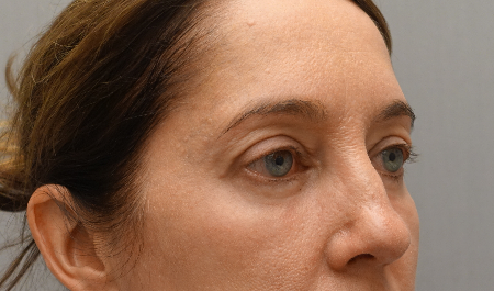 Lower Eyelid Blepharoplasty Patient #3 After Photo Thumbnail # 4