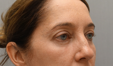 Lower Eyelid Blepharoplasty Patient #3 After Photo # 4