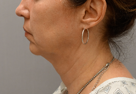 Jowl/Jawline Contouring Kybella Patient #6 After Photo Thumbnail # 8