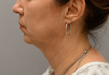 Jowl/Jawline Contouring Kybella Patient #6 After Photo # 8