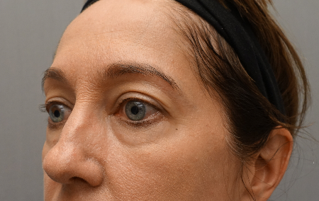 Lower Eyelid Blepharoplasty Patient #3 Before Photo Thumbnail # 5