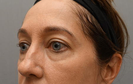 Lower Eyelid Blepharoplasty Patient #3 Before Photo # 5