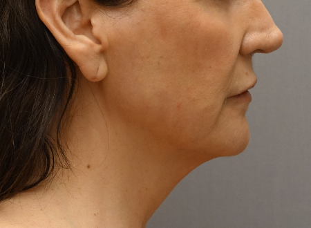 After Image: Jowl/Jawline Contouring Kybella Patient #1 -