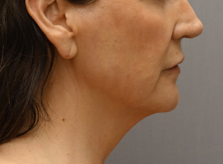 Jowl/Jawline Contouring Kybella Patient #1 After Photo # 4