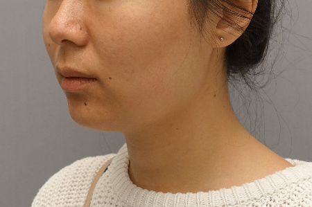 Kybella Patient #18 After Photo Thumbnail # 8