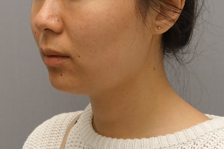 Kybella Patient #18 After Photo # 8