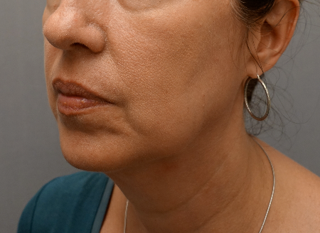 Jowl/Jawline Contouring Kybella Patient #6 Before Photo # 5