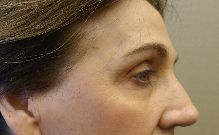 Upper and Lower Eyelid Blepharoplasty Patient #5 Before Photo Thumbnail # 5