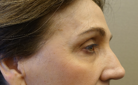 Upper and Lower Eyelid Blepharoplasty Patient #5 Before Photo # 5