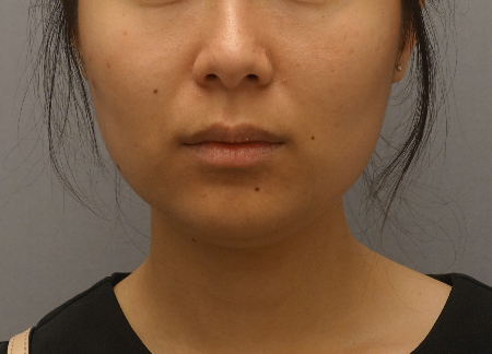 Kybella Patient #18 Before Photo # 1