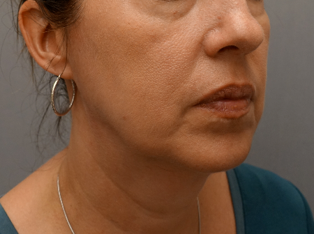 Jowl/Jawline Contouring Kybella Patient #6 Before Photo Thumbnail # 3