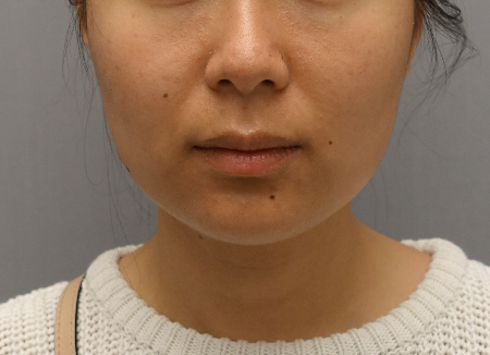 Kybella Patient #18 After Photo Thumbnail # 2