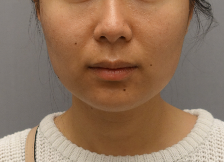 Kybella Patient