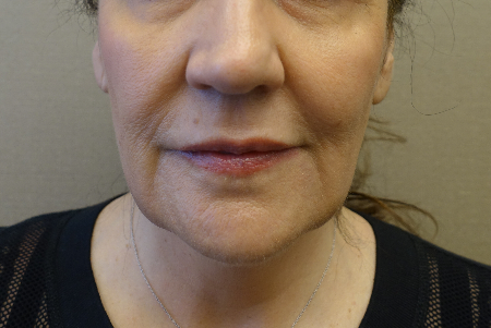 Jowl/Jawline Contouring Kybella Patient #1 Before Photo Thumbnail # 1