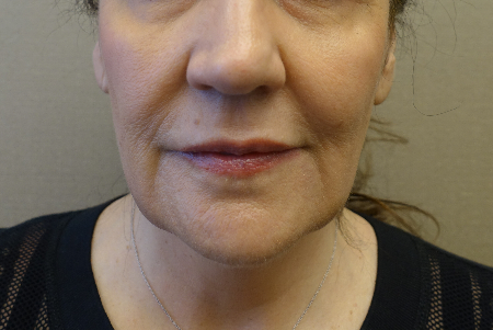 Before Image: Jowl/Jawline Contouring Kybella Patient #1 - 
