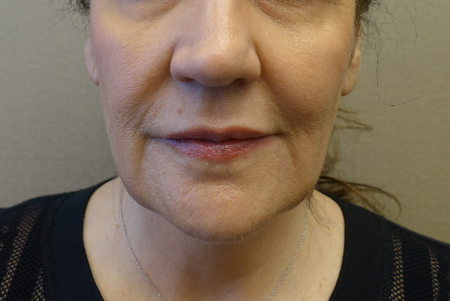 Kybella (Body Contouring) Patient