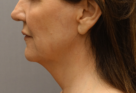 After Image: Jowl/Jawline Contouring Kybella Patient #1 -