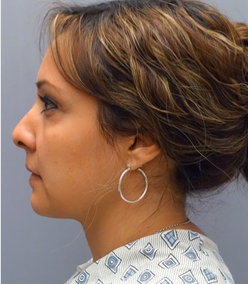 Liposuction Patient #27 After Photo # 4