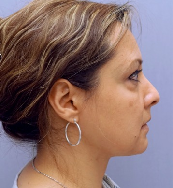 Liposuction Patient #27 After Photo # 2