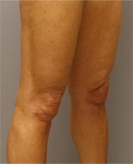 Knee Contouring Kybella Patient #1 After Photo # 12