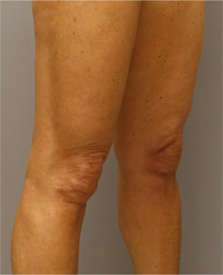 After Image: Knee Contouring Kybella Patient #1 -