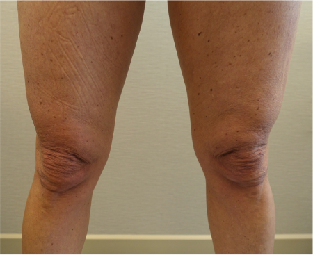 Knee Contouring Kybella Patient #1 Before Photo # 3
