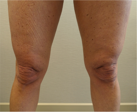Before Image: Knee Contouring Kybella Patient #1 -