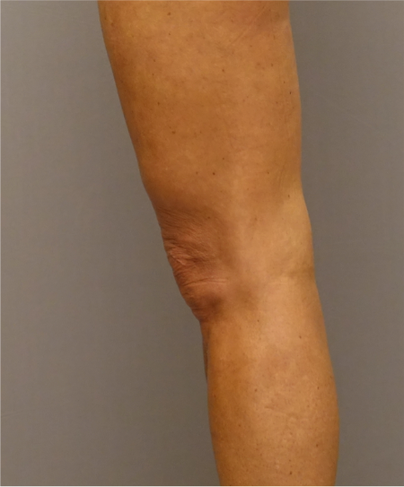 Knee Contouring Kybella Patient #1 After Photo # 8
