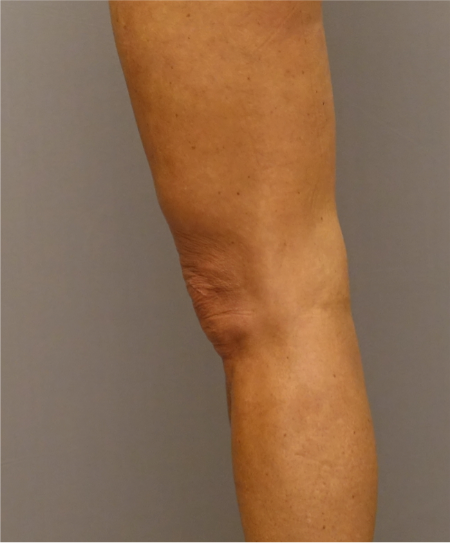 After Image: Knee Contouring Kybella Patient #1 -