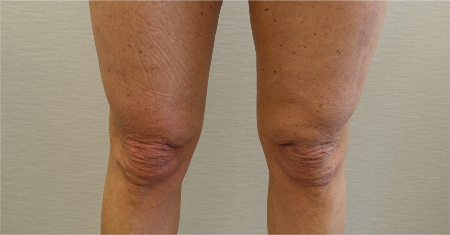 Before Image: Knee Contouring Kybella Patient #1 - 