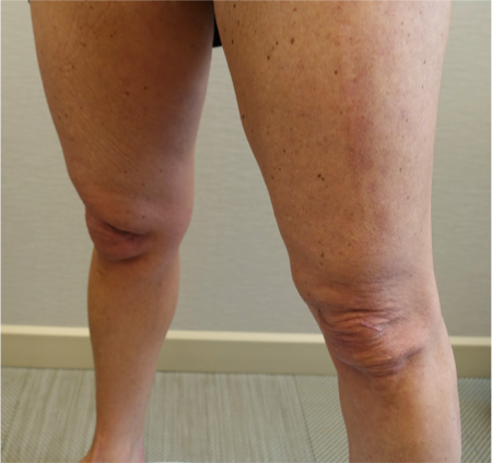 Knee Contouring Kybella Patient #1 Before Photo Thumbnail # 5