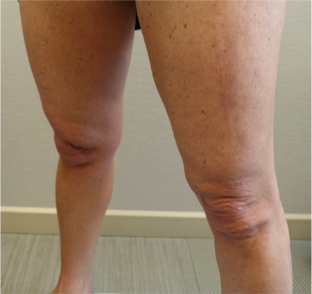 Before Image: Knee Contouring Kybella Patient #1 -