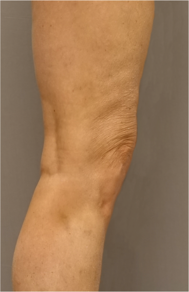 Knee Contouring Kybella Patient #2 After Photo # 8