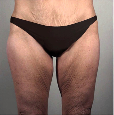 Thigh-Lift Patient #2 Before Photo # 1