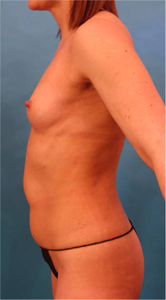 Breast Augmentation (Fat) Patient #2 Before Photo Thumbnail # 3