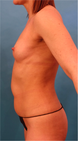 Before Image: Breast Augmentation (Fat) Patient #2 -