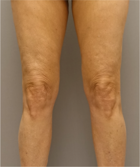 Knee Contouring Kybella Patient #2 After Photo Thumbnail # 2