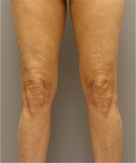 Knee Contouring Kybella Patient #2 After Photo # 2